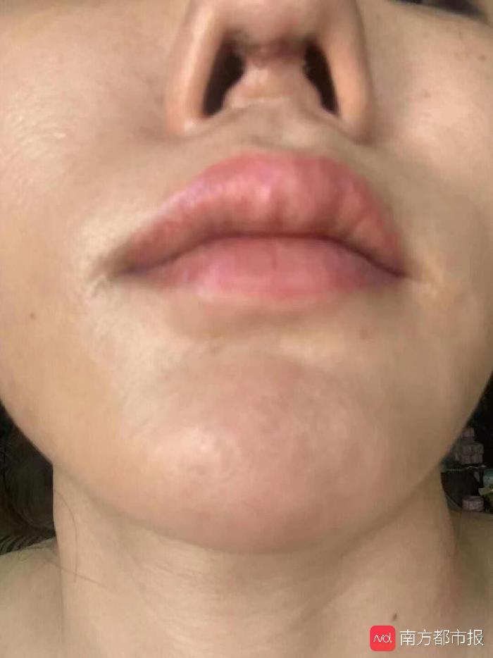 广州一女子花8万元做隆鼻手术,拆纱布发现鼻子少块肉